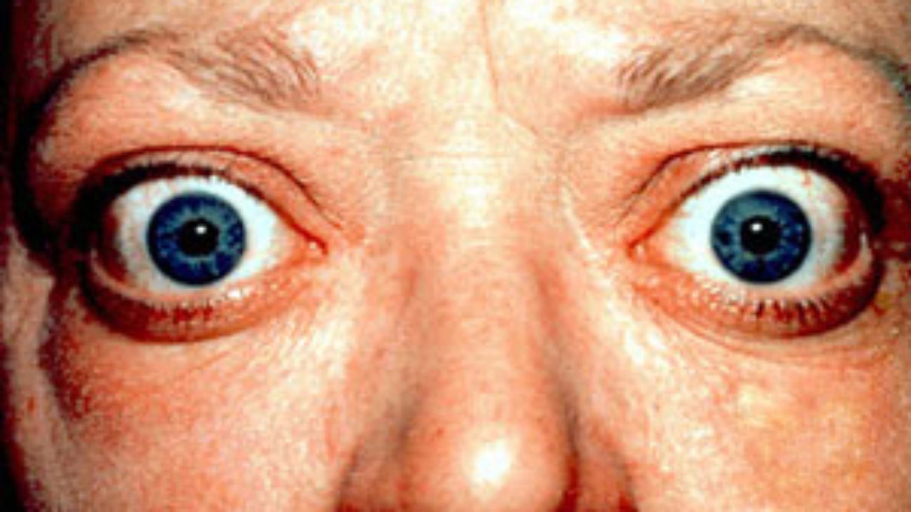 Proptosis_and_lid_retraction_from_Graves'_Disease