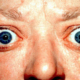 Proptosis_and_lid_retraction_from_Graves'_Disease