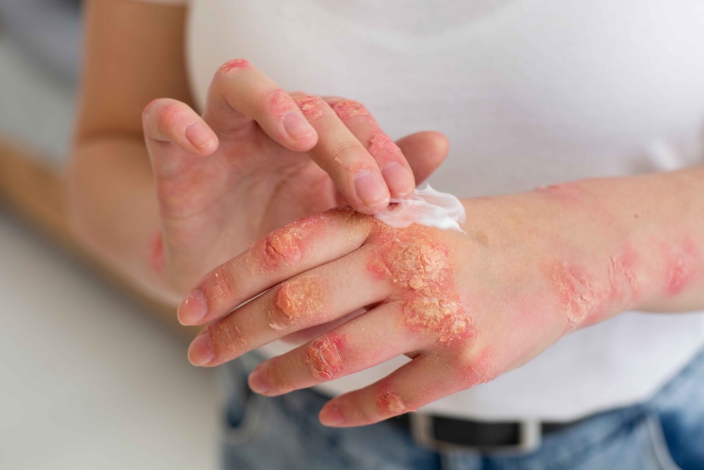 hands-patient-suffering-from-psoriasis_11zon