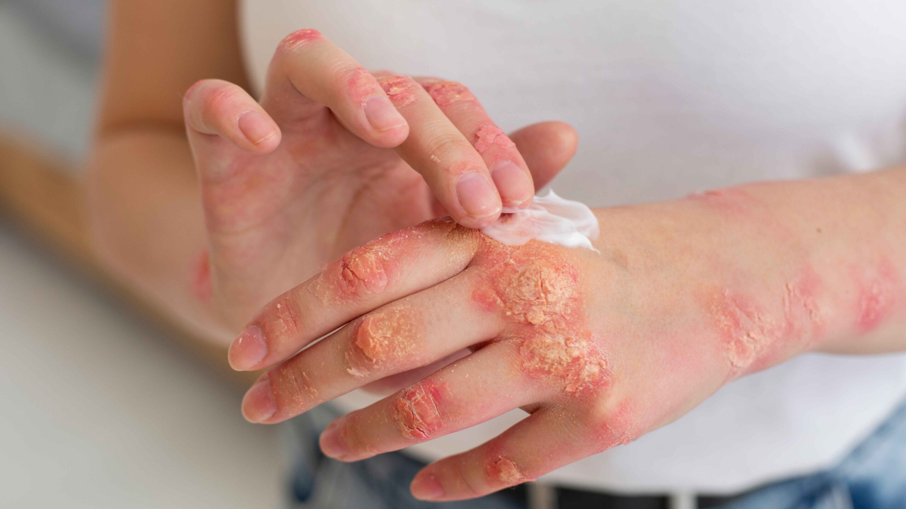 hands-patient-suffering-from-psoriasis_11zon
