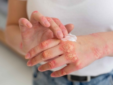 hands-patient-suffering-from-psoriasis_11zon