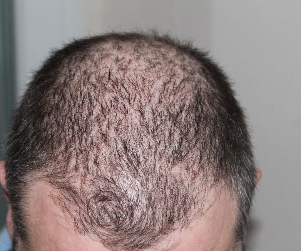 hair, man, hair loss, head, hair loss, hair loss, hair loss, hair loss, hair loss
