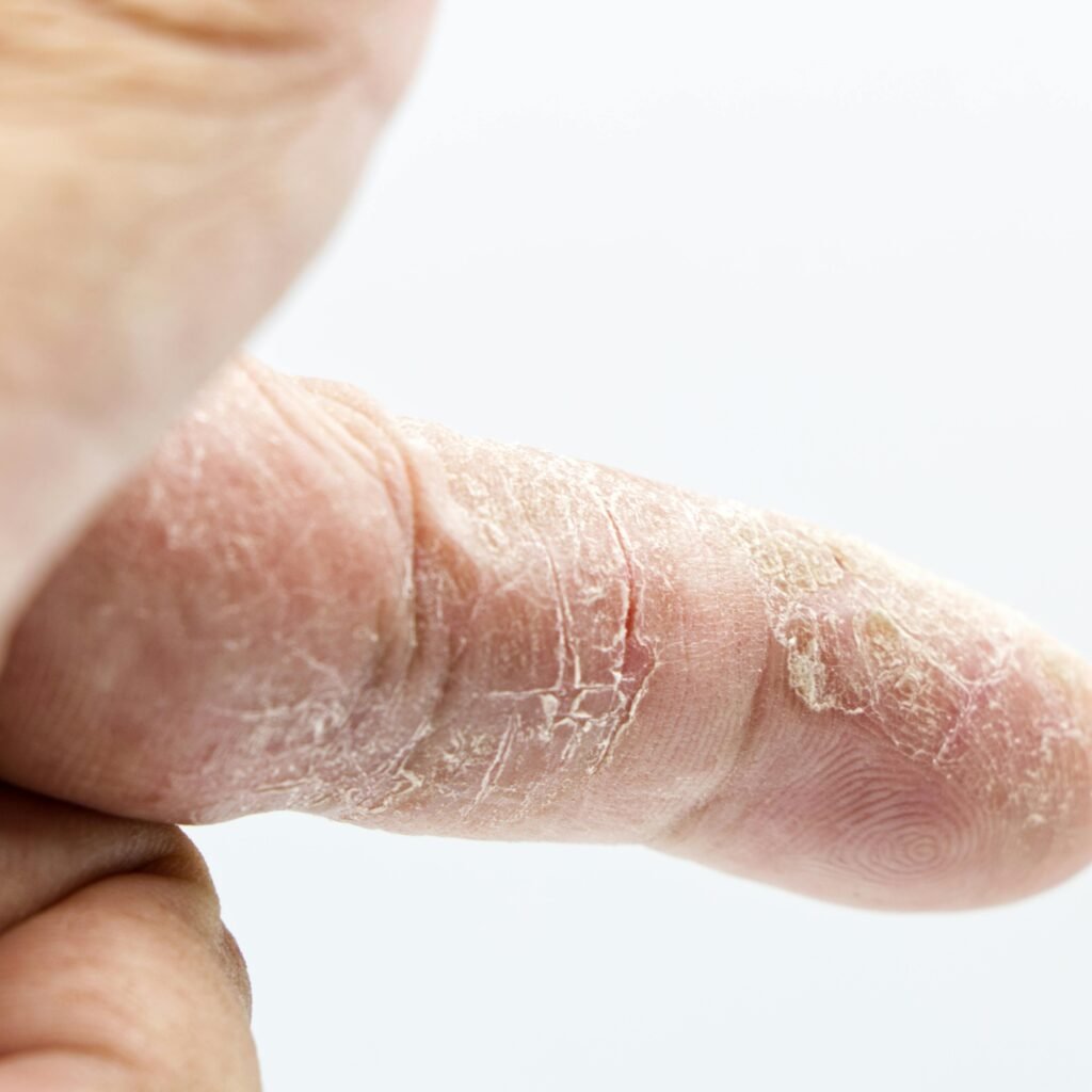 Detailed close-up of a human finger with dry and calloused skin showcasing texture and skin condition.