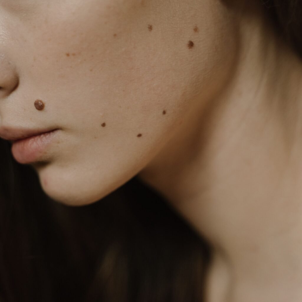 Detailed close-up of a woman's face, focusing on skin with multiple moles.