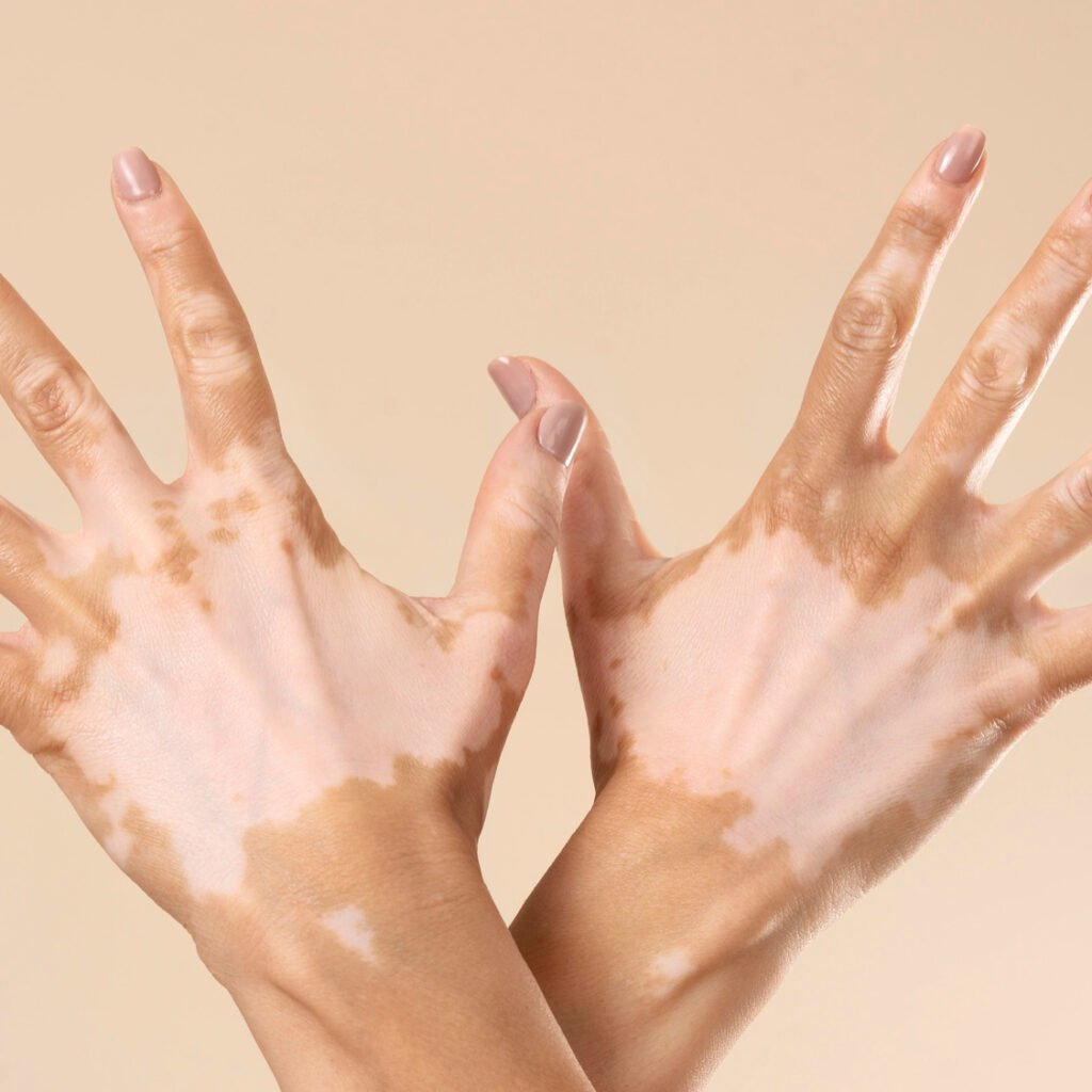Pfizer LITFULO (ritlecitinib) demonstrated significant facial and total body repigmentation in Phase 3 TRANQUILLO trials for adults with nonsegmental vitiligo.