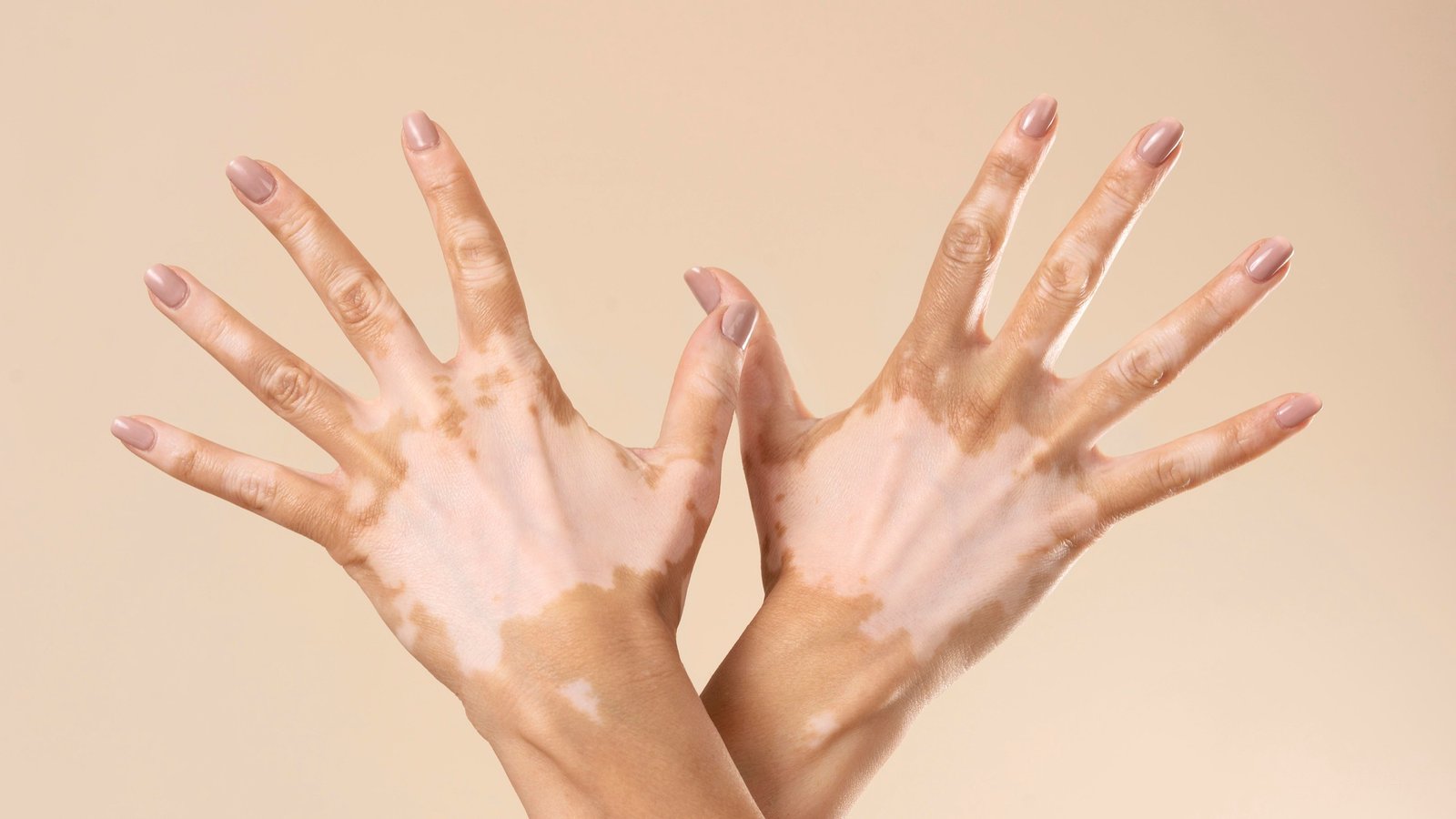 Pfizer LITFULO (ritlecitinib) demonstrated significant facial and total body repigmentation in Phase 3 TRANQUILLO trials for adults with nonsegmental vitiligo.