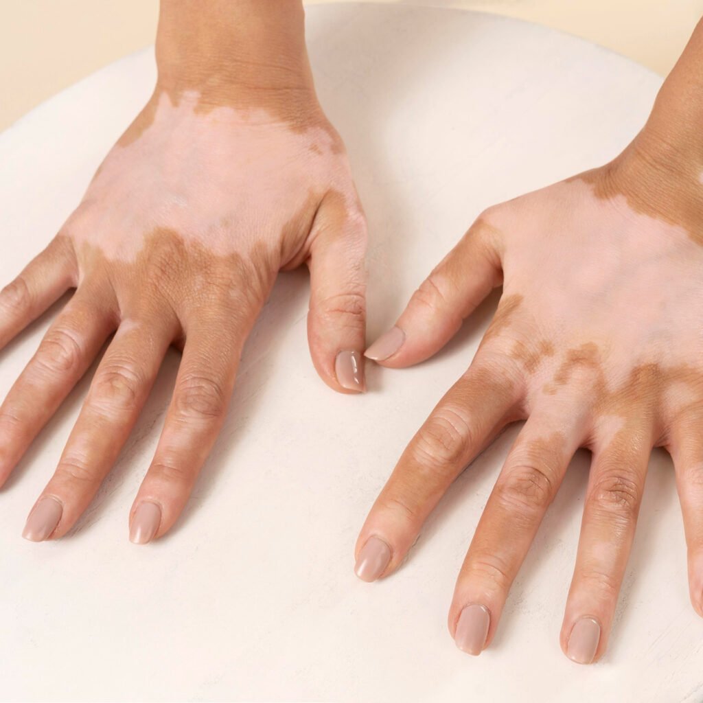 Illustration of skin repigmentation in non-segmental vitiligo representing positive Phase II clinical trial results of InnoCare's oral TYK2 inhibitor soficitinib (ICP-332).