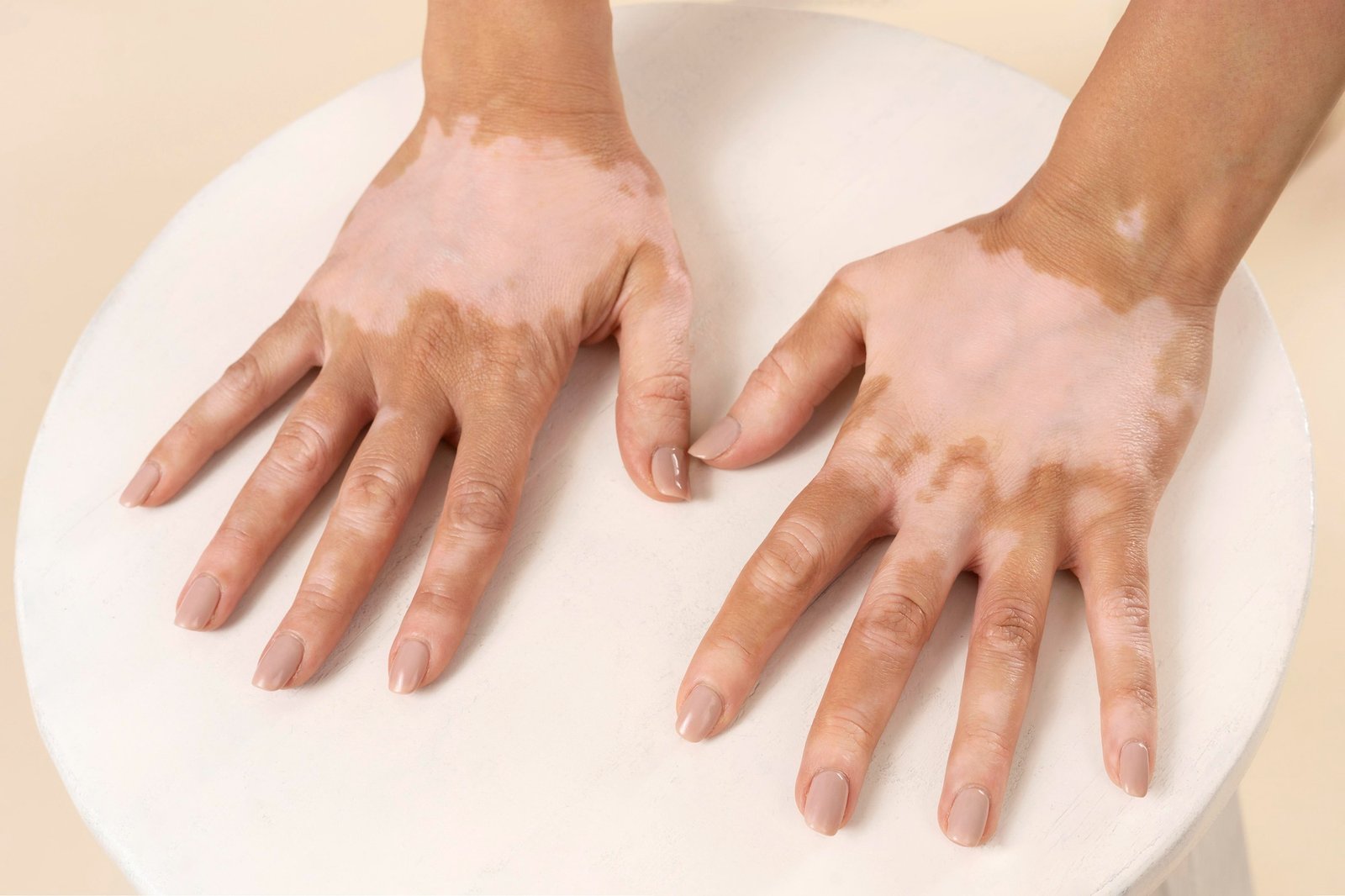 Illustration of skin repigmentation in non-segmental vitiligo representing positive Phase II clinical trial results of InnoCare's oral TYK2 inhibitor soficitinib (ICP-332).