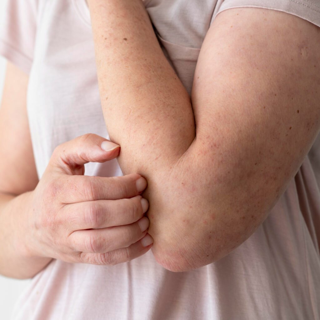 Celldex's investigational anti-KIT monoclonal antibody barzolvolimab in Phase 2 clinical trial for prurigo nodularis after missing primary efficacy endpoint.