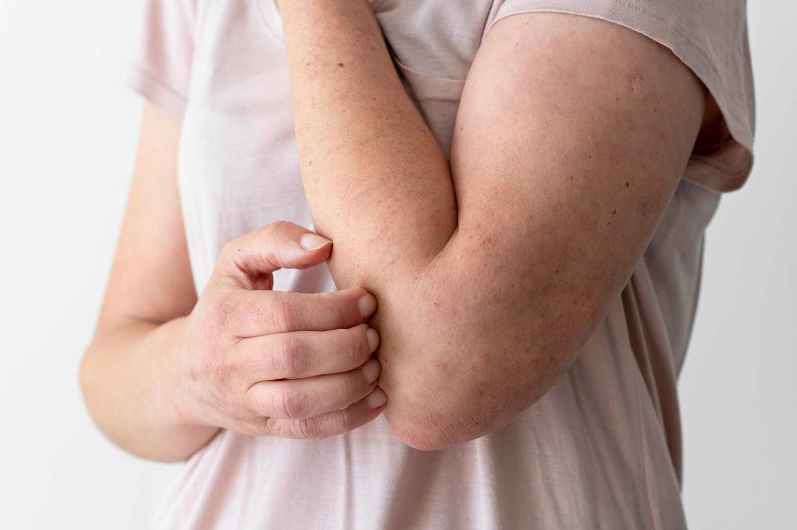Celldex's investigational anti-KIT monoclonal antibody barzolvolimab in Phase 2 clinical trial for prurigo nodularis after missing primary efficacy endpoint.