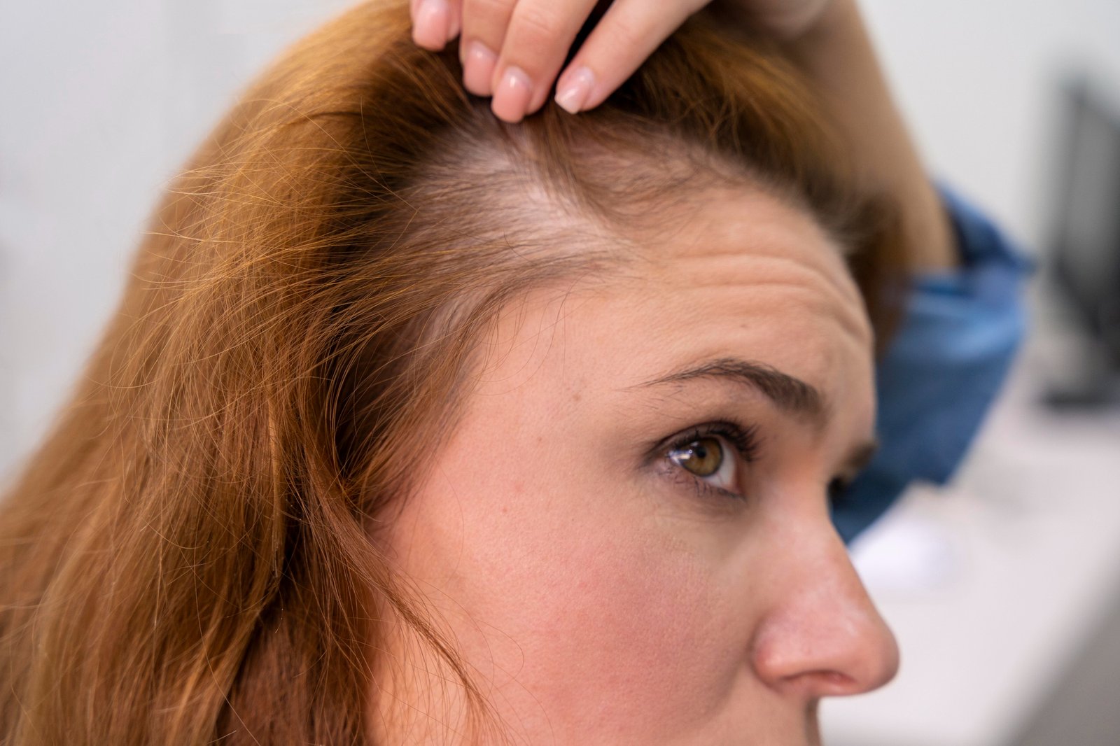 Veradermics VDPHL01 extended-release oral minoxidil Phase 2 trial showed positive hair growth results in women with female pattern hair loss.