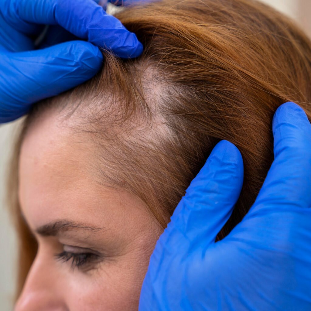 Illustration of scalp hair regrowth representing positive Phase 2 SIGNAL-AA trial results for Q32 Bio's bempikibart in severe alopecia areata.