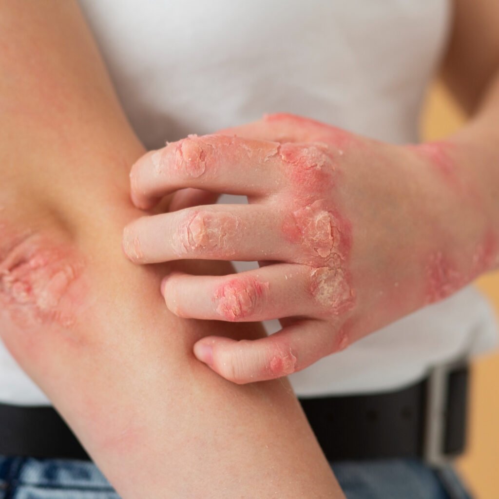 Illustration of InnoCare Pharma's oral TYK2 inhibitor soficitinib (ICP-332) achieving the primary endpoint in a Phase III trial for moderate-to-severe atopic dermatitis.