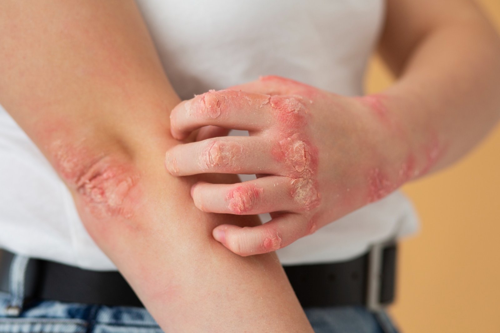 Illustration of InnoCare Pharma's oral TYK2 inhibitor soficitinib (ICP-332) achieving the primary endpoint in a Phase III trial for moderate-to-severe atopic dermatitis.