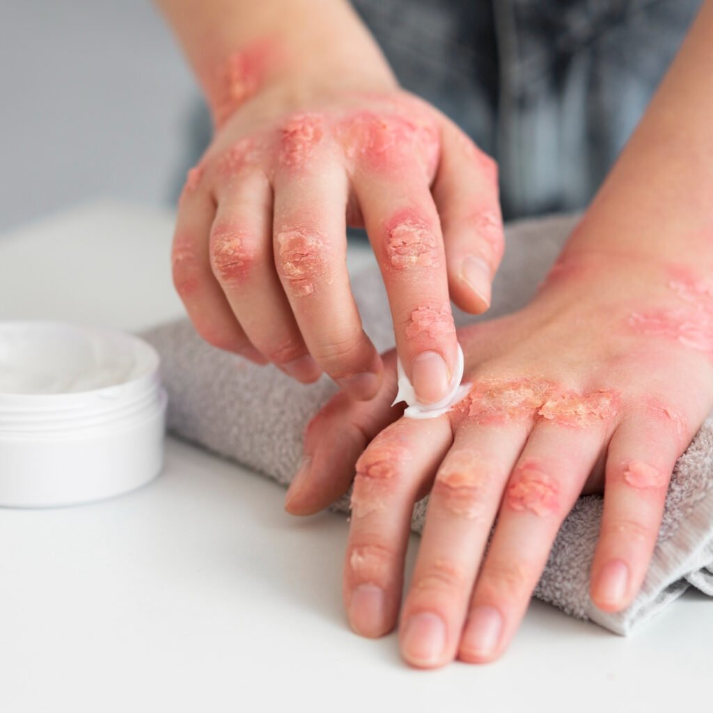 Opzelura (ruxolitinib) cream receives positive CHMP opinion for adults with moderate atopic dermatitis in the European Union.
