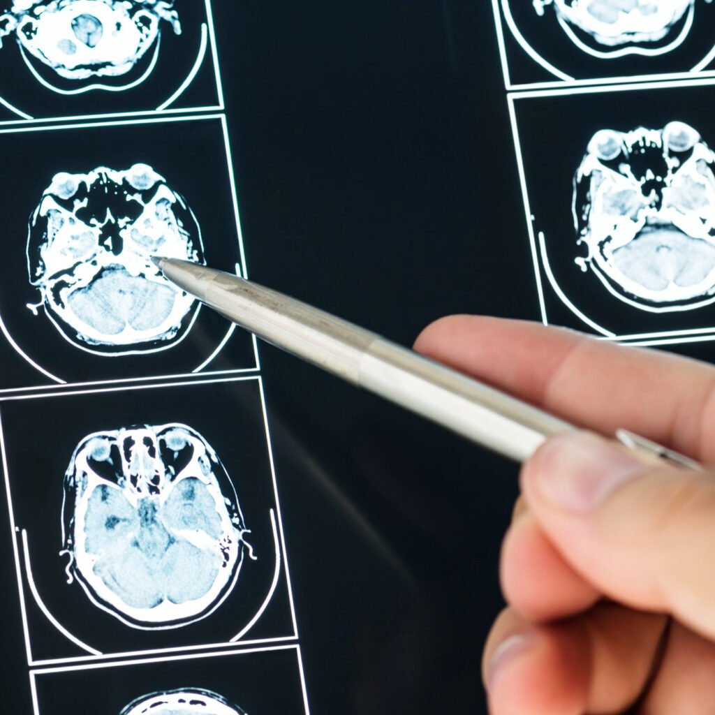Illustration of brain tumor imaging representing safusidenib Phase 2 results in patients with IDH1-mutant grade 2 glioma and expansion into Phase 3 clinical trials.