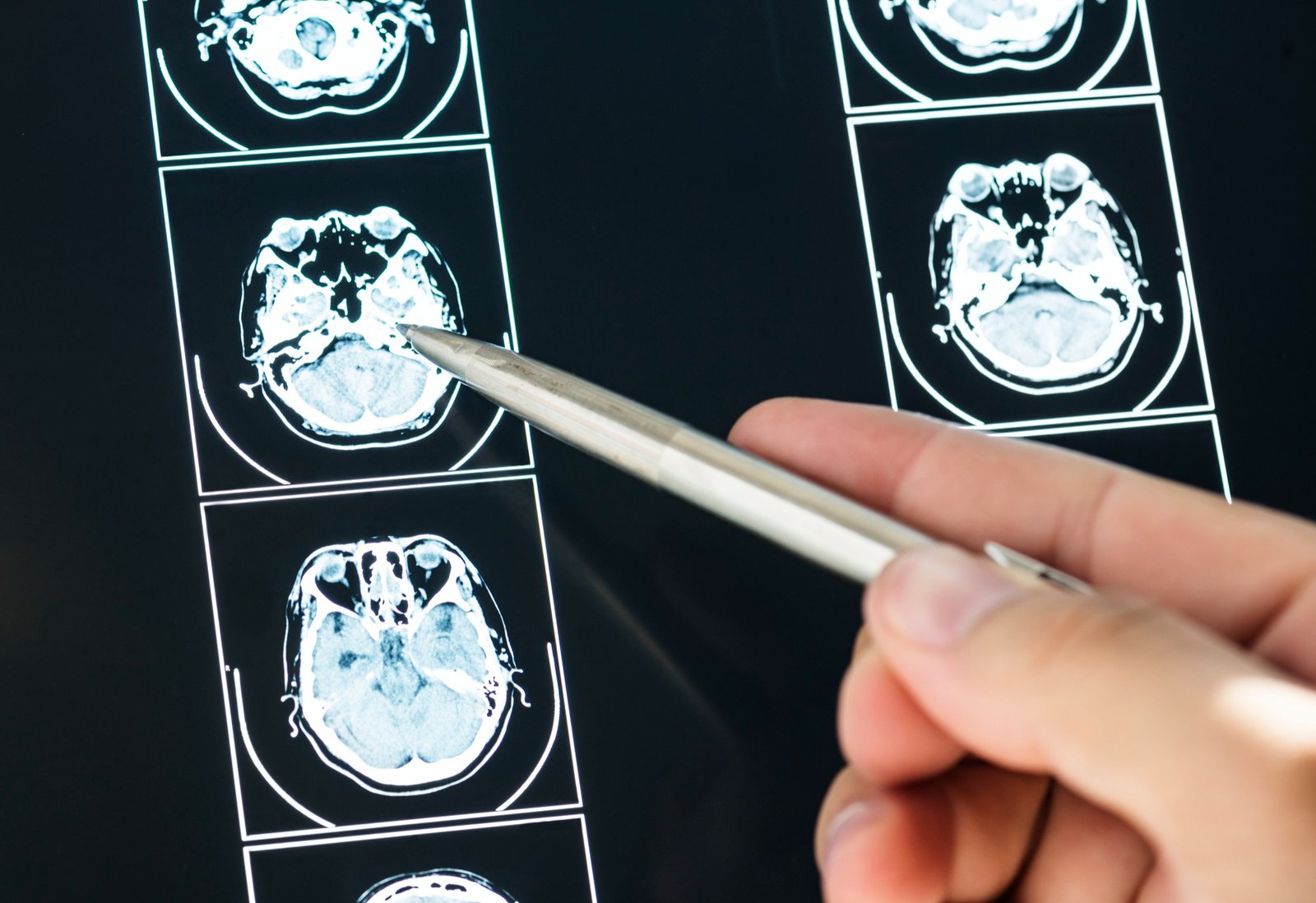 Illustration of brain tumor imaging representing safusidenib Phase 2 results in patients with IDH1-mutant grade 2 glioma and expansion into Phase 3 clinical trials.
