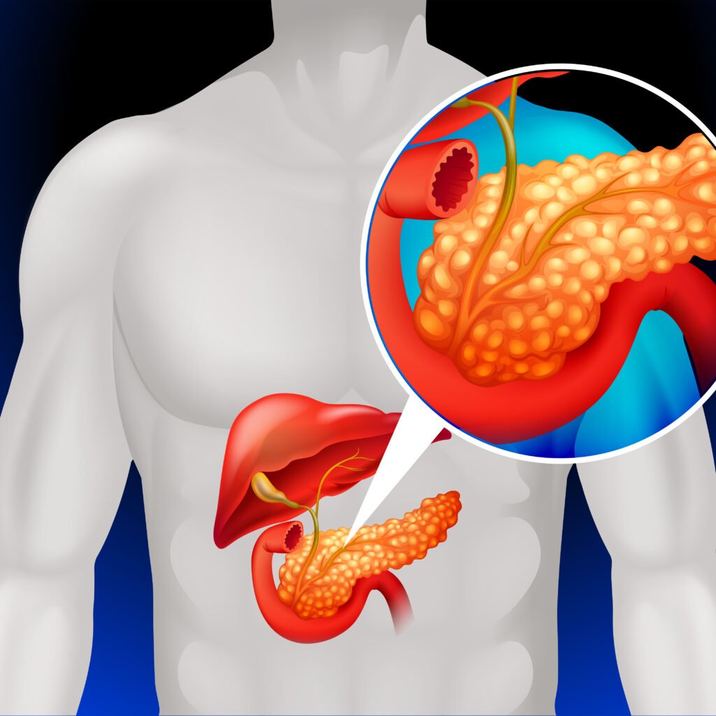 Illustration of KRAS G12C-mutant pancreatic cancer cells with olomorasib targeted therapy following FDA Breakthrough Therapy designation for previously treated advanced pancreatic cancer.
