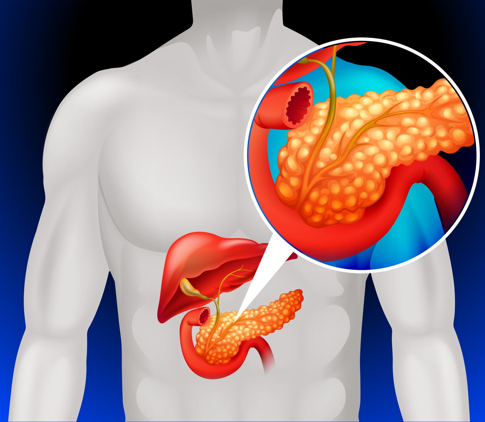Illustration of KRAS G12C-mutant pancreatic cancer cells with olomorasib targeted therapy following FDA Breakthrough Therapy designation for previously treated advanced pancreatic cancer.