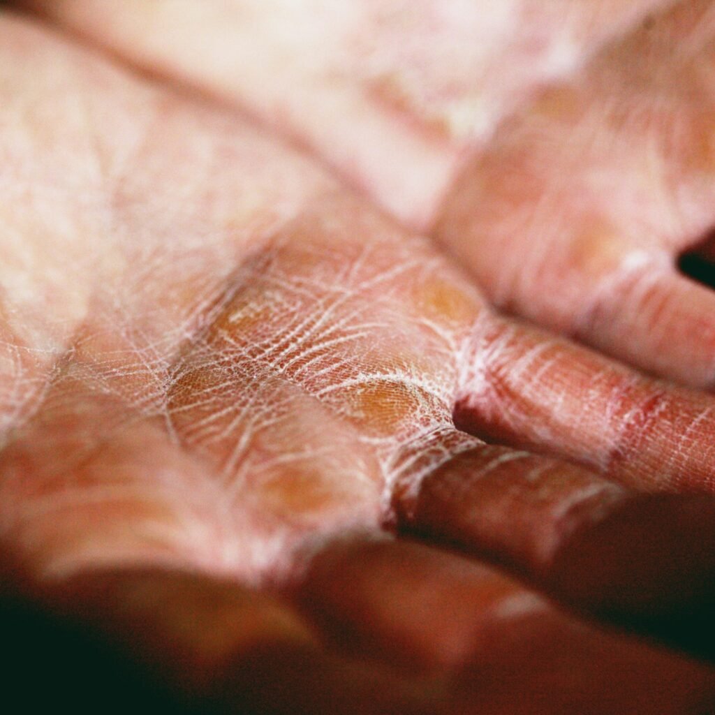 Illustration of plaque psoriasis affecting the scalp, nails, palms, and soles highlighting Phase 3 results of Takeda's investigational TYK2 inhibitor zasocitinib (TAK-279).