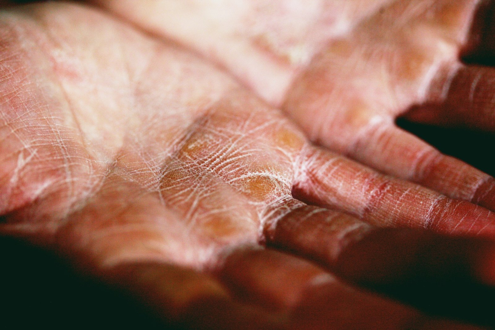 Illustration of plaque psoriasis affecting the scalp, nails, palms, and soles highlighting Phase 3 results of Takeda's investigational TYK2 inhibitor zasocitinib (TAK-279).