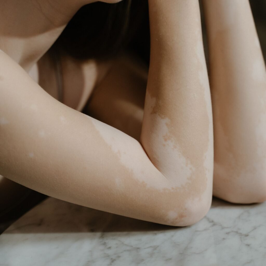 A close-up image showcasing vitiligo on a woman's arms, highlighting skin diversity and self-love.