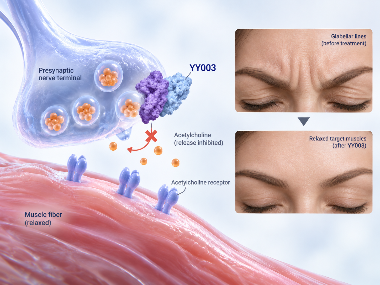 Revelyx Bio YY003 recombinant botulinum toxin type A Phase 2 trial for glabellar lines