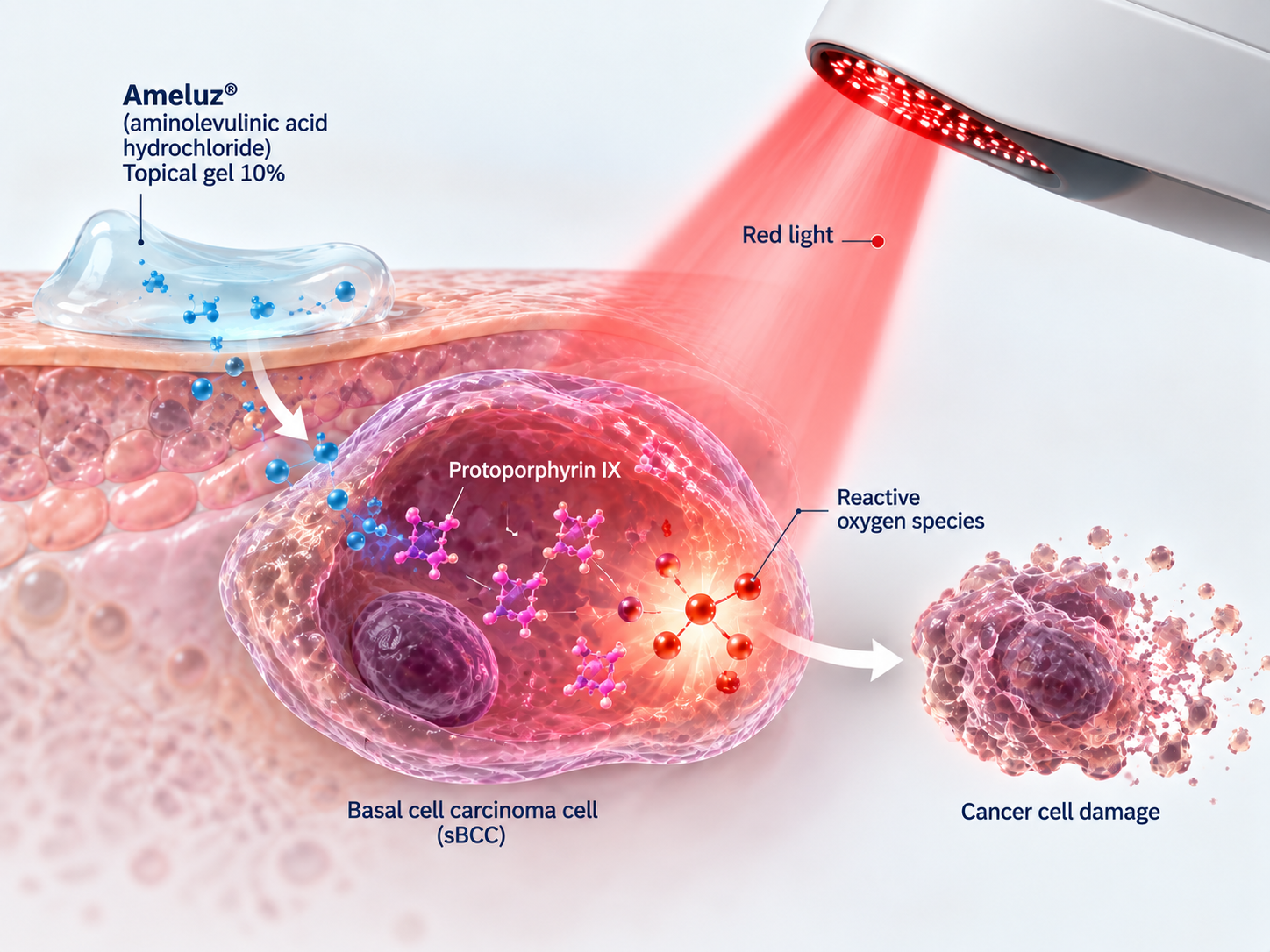 Ameluz photodynamic therapy with BF-RhodoLED for superficial basal cell carcinoma