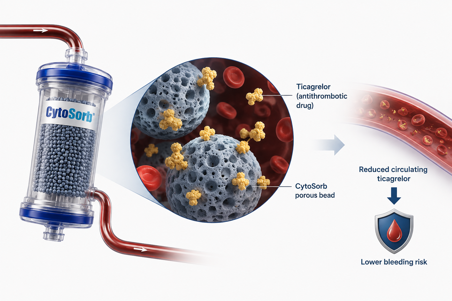 CytoSorb device used during urgent CABG to remove ticagrelor and reduce severe bleeding