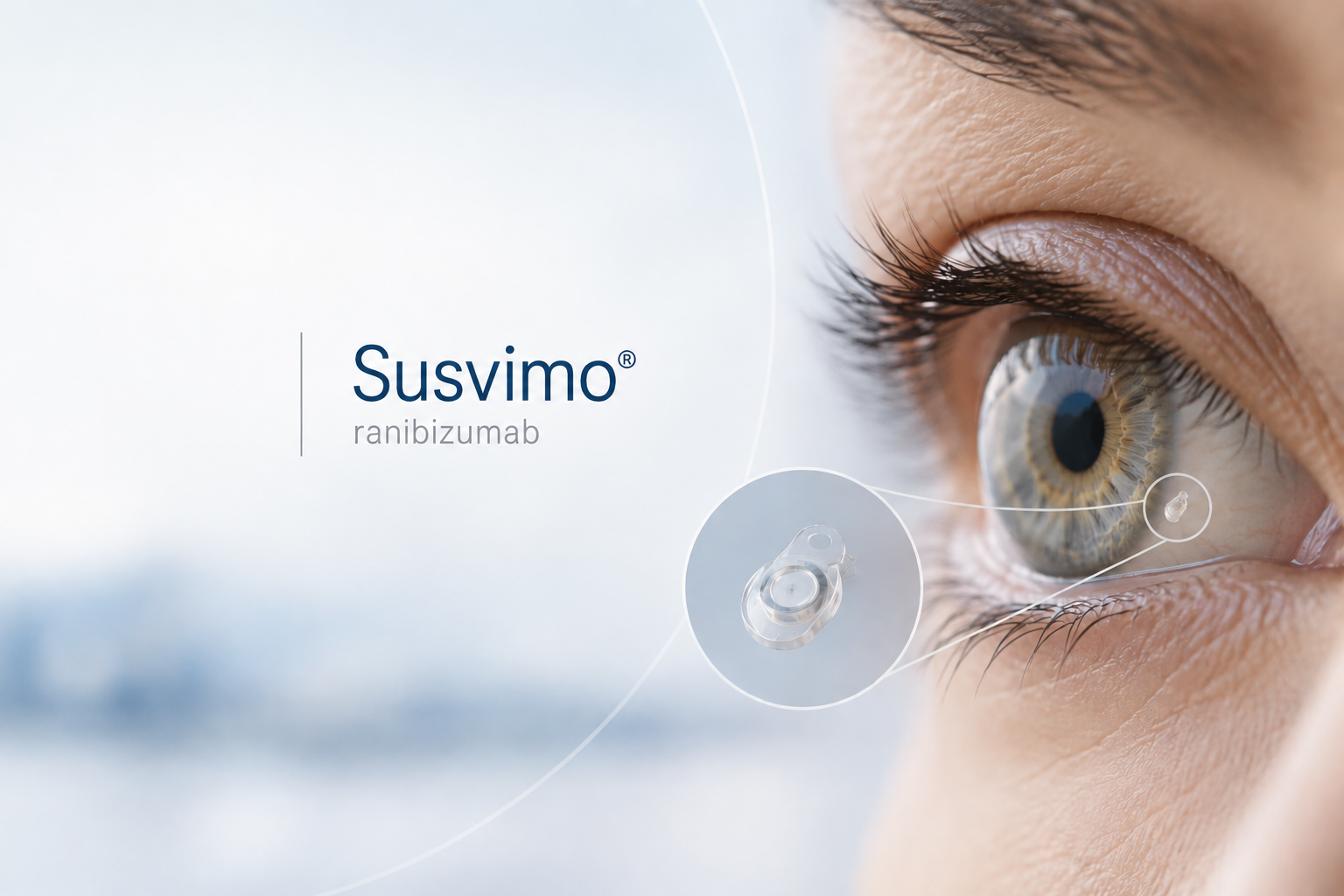 Roche Susvimo refillable ocular implant delivering ranibizumab for neovascular age-related macular degeneration