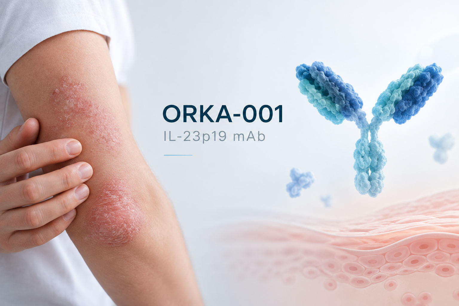 ORKA-001 IL-23p19 monoclonal antibody shows sustained PASI 100 response in plaque psoriasis through Week 28