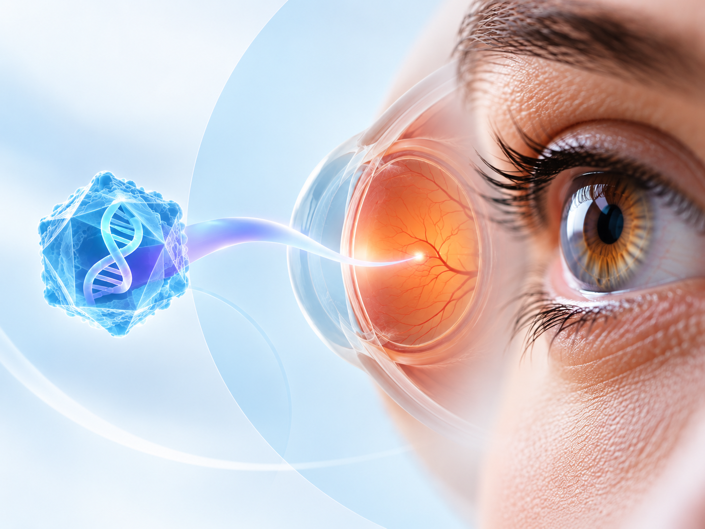 Sura-vec gene therapy administered by suprachoroidal delivery for diabetic retinopathy