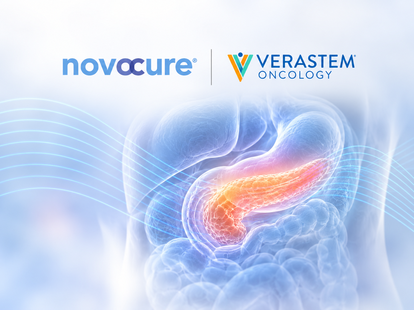 Tumor Treating Fields therapy and investigational KRAS G12D inhibitor VS-7375 being evaluated with chemotherapy for locally advanced pancreatic cancer