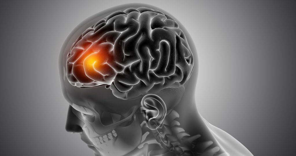 Illustration of BPM31510 mitochondrial therapy combined with radiation and temozolomide for newly diagnosed glioblastoma following encouraging Phase 2 survival results presented at ASCO 2026.