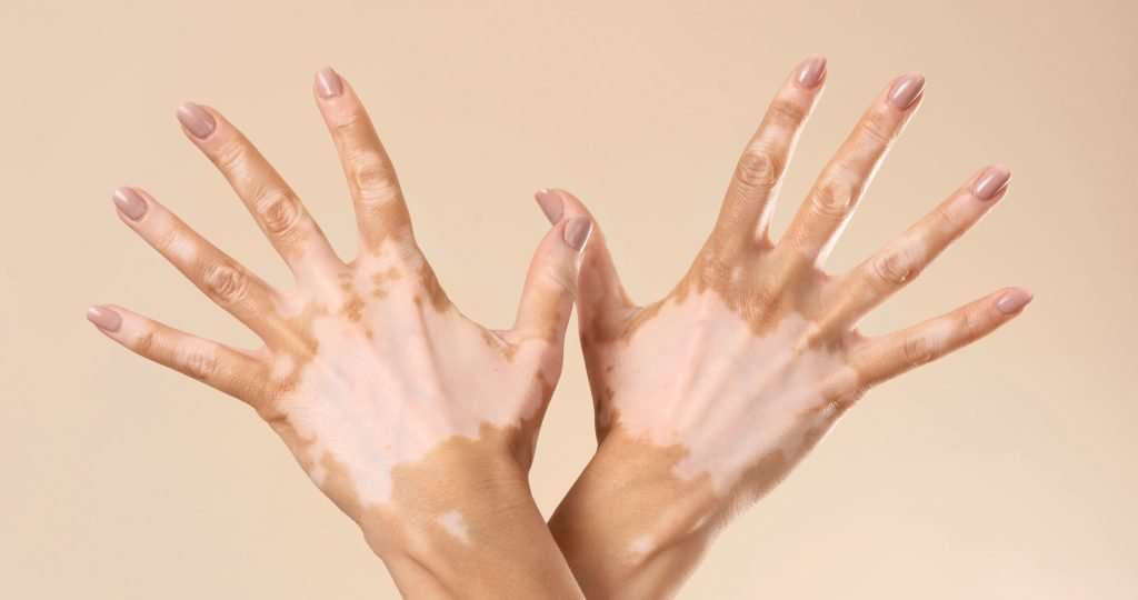Pfizer LITFULO (ritlecitinib) demonstrated significant facial and total body repigmentation in Phase 3 TRANQUILLO trials for adults with nonsegmental vitiligo.
