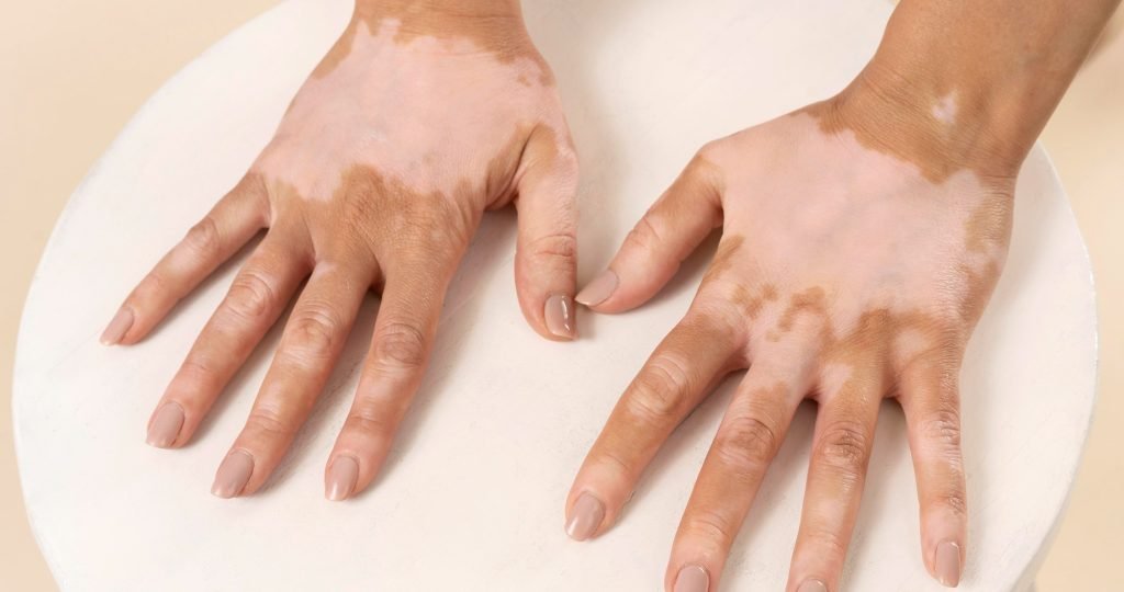 Illustration of skin repigmentation in non-segmental vitiligo representing positive Phase II clinical trial results of InnoCare's oral TYK2 inhibitor soficitinib (ICP-332).