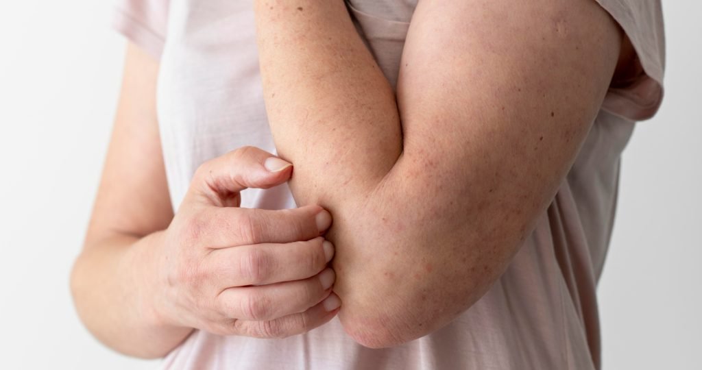 Celldex's investigational anti-KIT monoclonal antibody barzolvolimab in Phase 2 clinical trial for prurigo nodularis after missing primary efficacy endpoint.