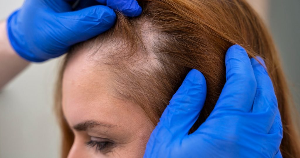Illustration of scalp hair regrowth representing positive Phase 2 SIGNAL-AA trial results for Q32 Bio's bempikibart in severe alopecia areata.