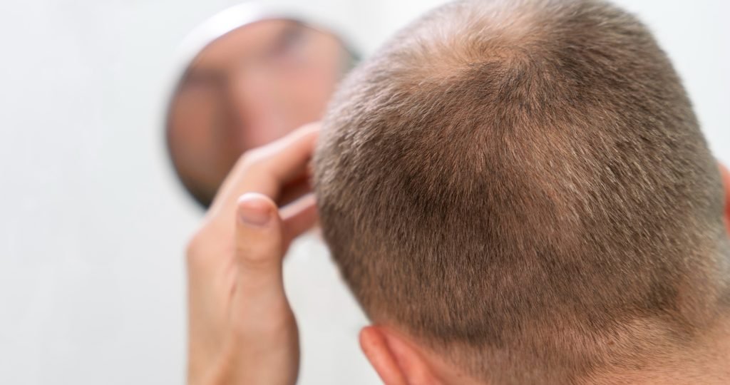 Veradermics presents Phase 2/3 Study 302 subgroup analysis showing VDPHL01 extended-release oral minoxidil efficacy and safety across age groups in men with pattern hair loss at the 2026 AAD Innovation Academy.