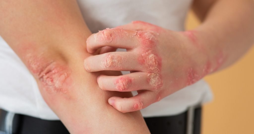 Illustration of InnoCare Pharma's oral TYK2 inhibitor soficitinib (ICP-332) achieving the primary endpoint in a Phase III trial for moderate-to-severe atopic dermatitis.