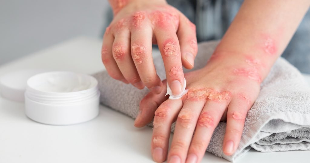 Illustration of VTAMA (tapinarof) cream improving atopic dermatitis severity across pediatric and adult patients based on pooled Phase 3 ADORING trial data presented at the 2026 Society for Pediatric Dermatology Annual Meeting.