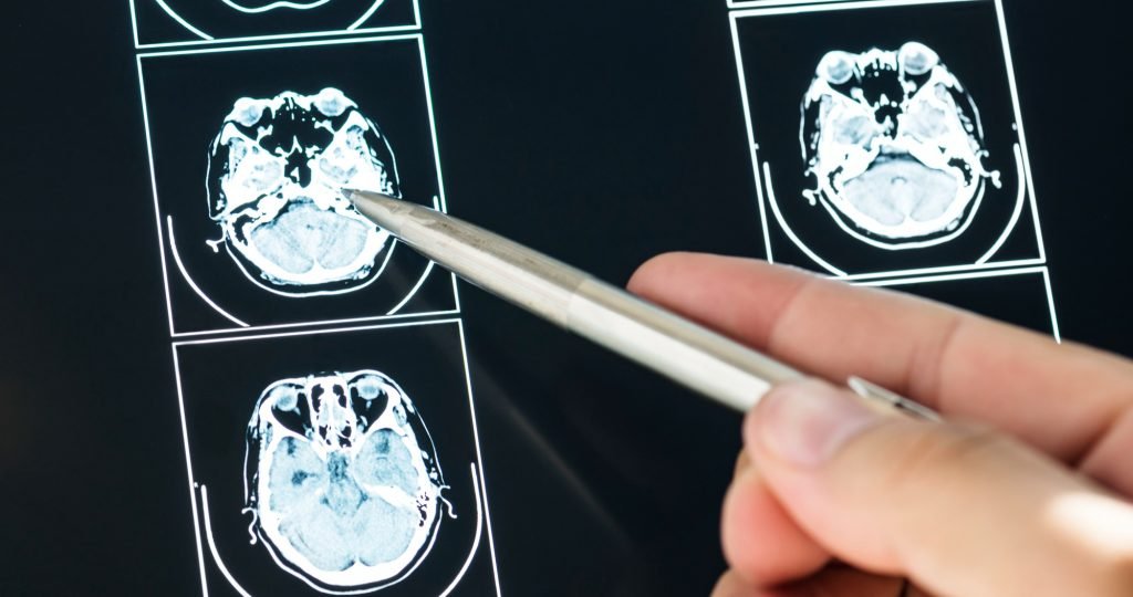 Illustration of brain tumor imaging representing safusidenib Phase 2 results in patients with IDH1-mutant grade 2 glioma and expansion into Phase 3 clinical trials.