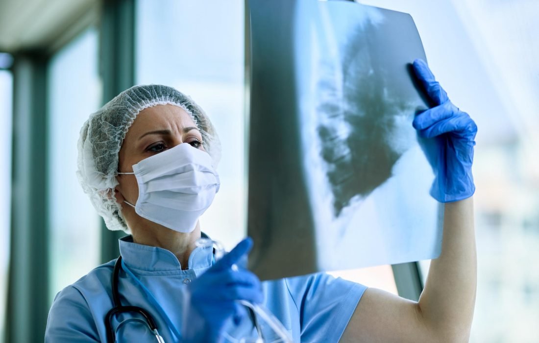 Fexlamose inhaled therapy targeting pathological airway mucus in patients with COPD
