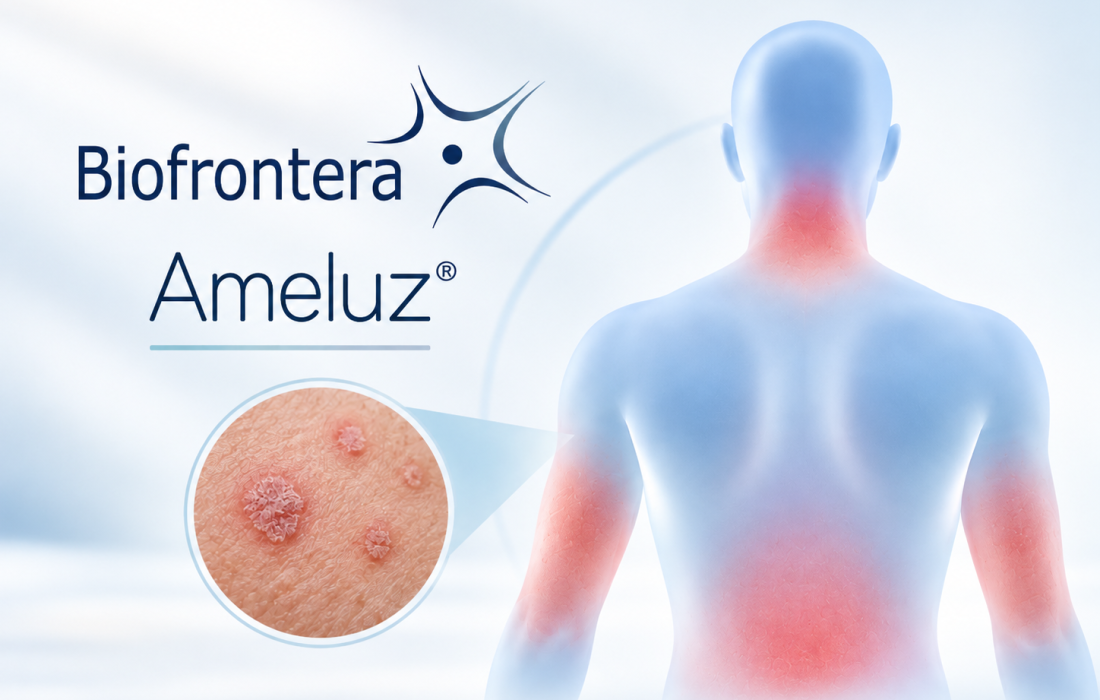 Biofrontera Ameluz photodynamic therapy for actinic keratoses beyond the face and scalp