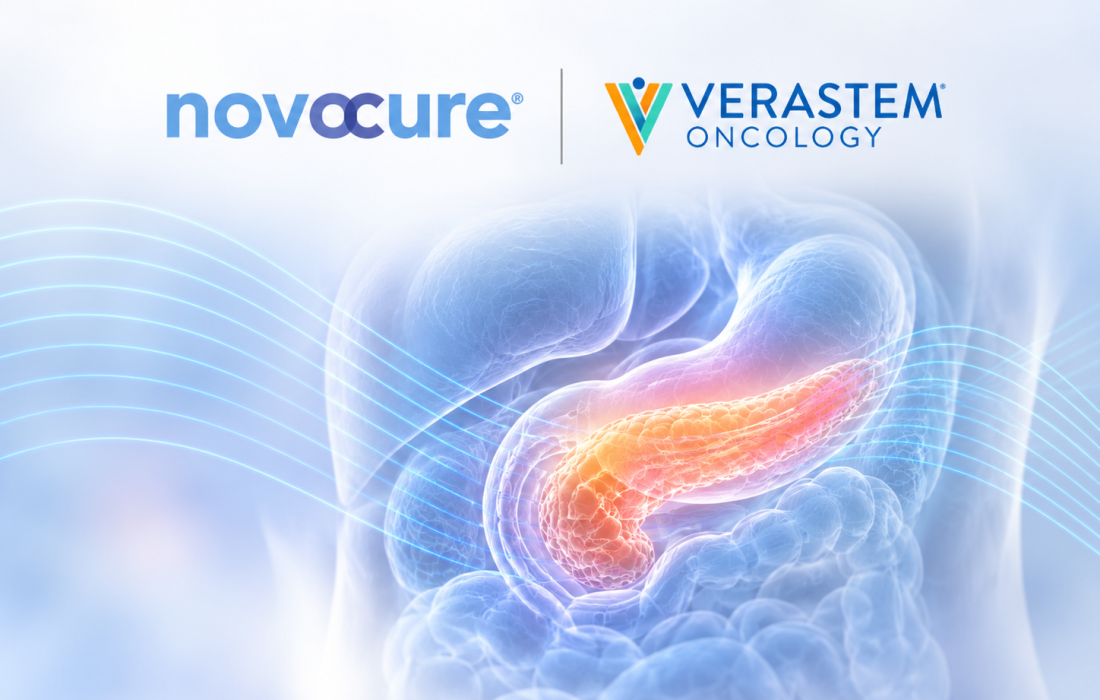 Tumor Treating Fields therapy and investigational KRAS G12D inhibitor VS-7375 being evaluated with chemotherapy for locally advanced pancreatic cancer