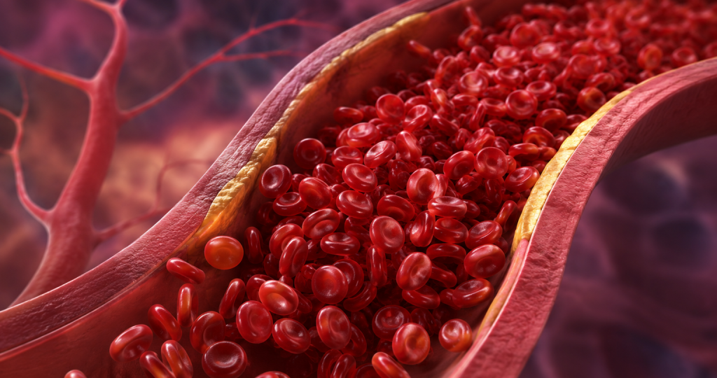 Divesiran Phase 2 SANRECO trial in patients with polycythemia vera