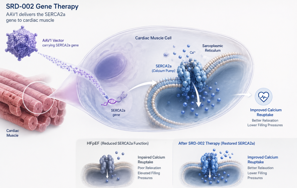 SRD-002 gene therapy shows sustained 12-month improvements in cardiac filling pressure in HFpEF