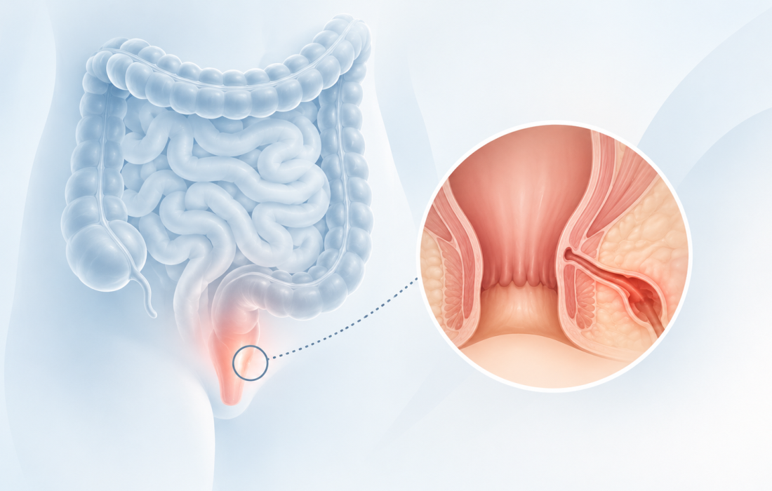 Medical illustration depicting perianal fistulizing Crohn’s disease and guselkumab treatment evaluated in the Phase 3 FUZION trial