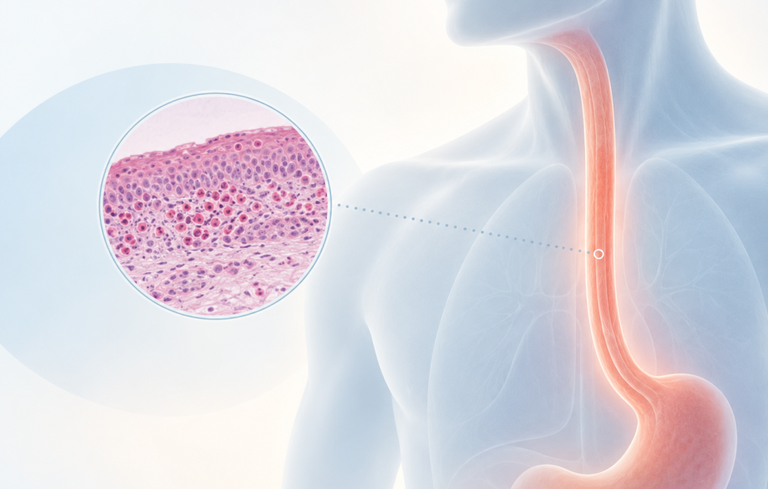 Medical illustration of eosinophilic esophagitis showing an inflamed esophagus and magnified esophageal tissue.