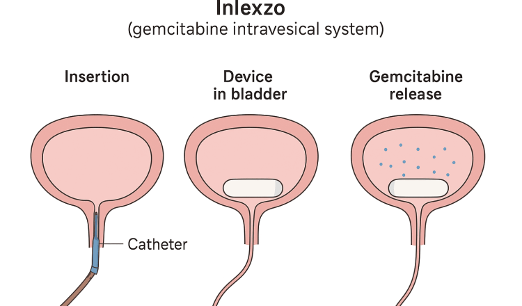 Inlexzo device_11zon